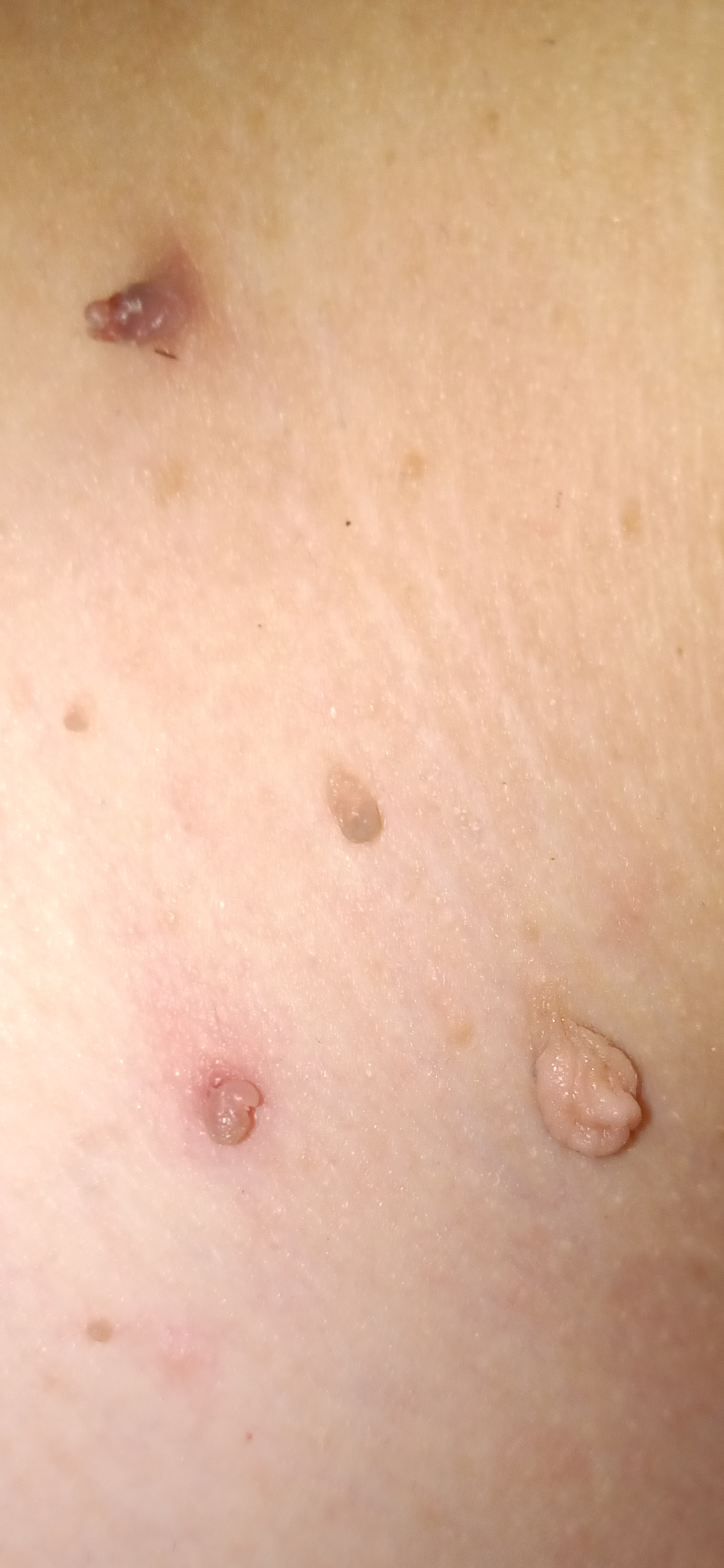 Fibroms extrem