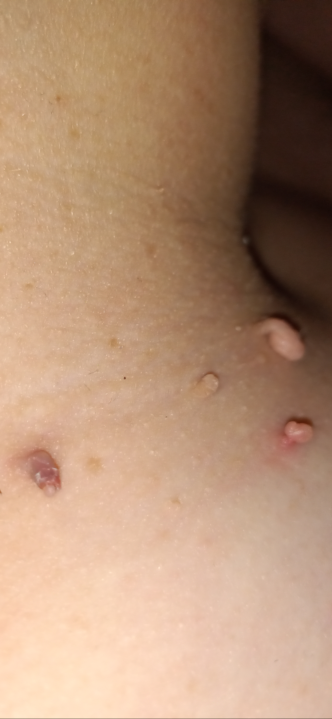 Fibroms extrem