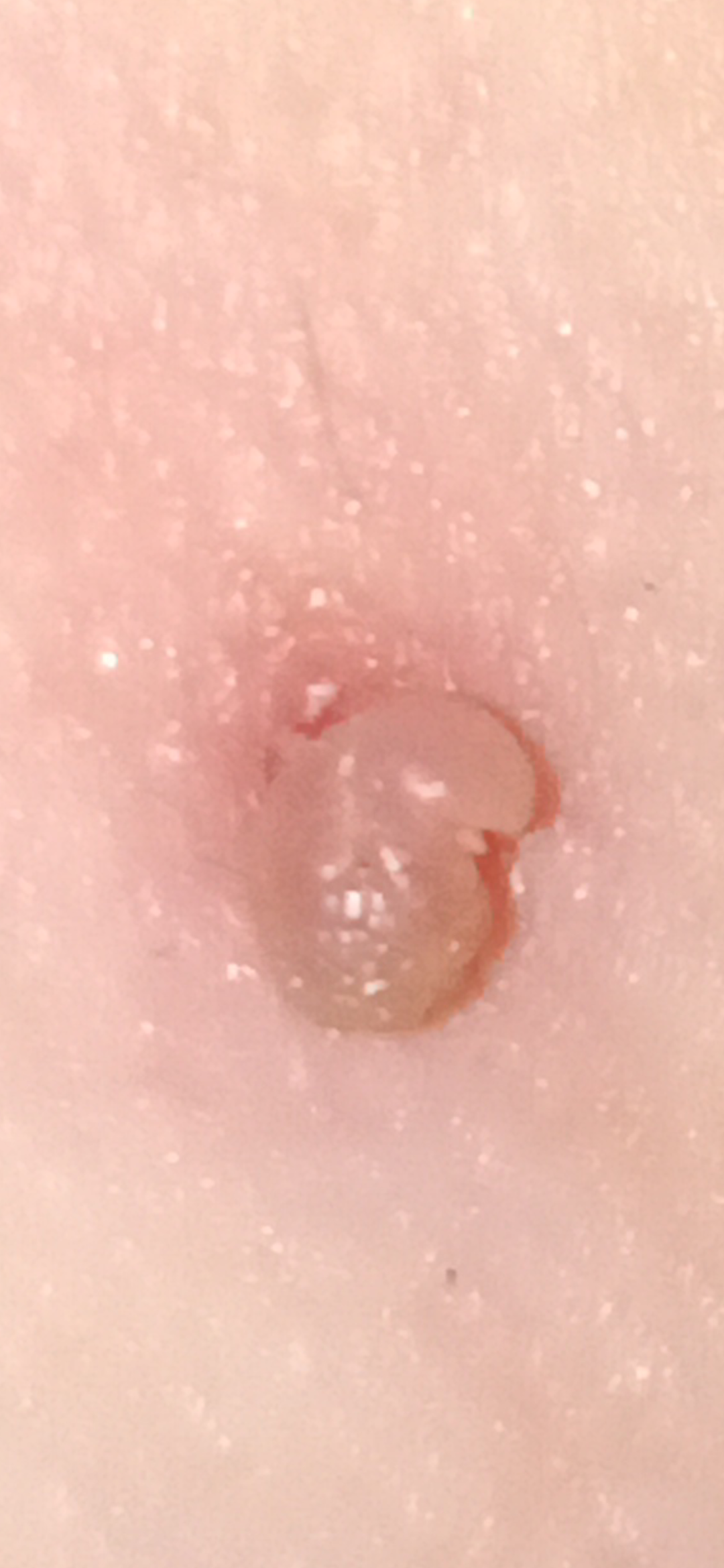 Fibroms extrem