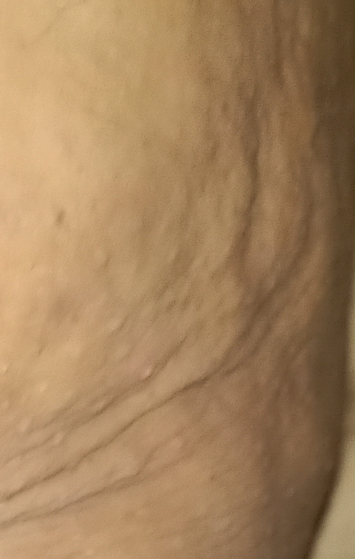 Cellulite