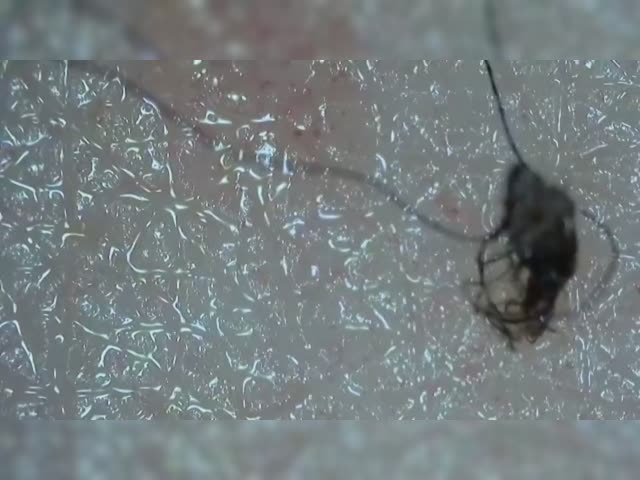 Morgellons moving
