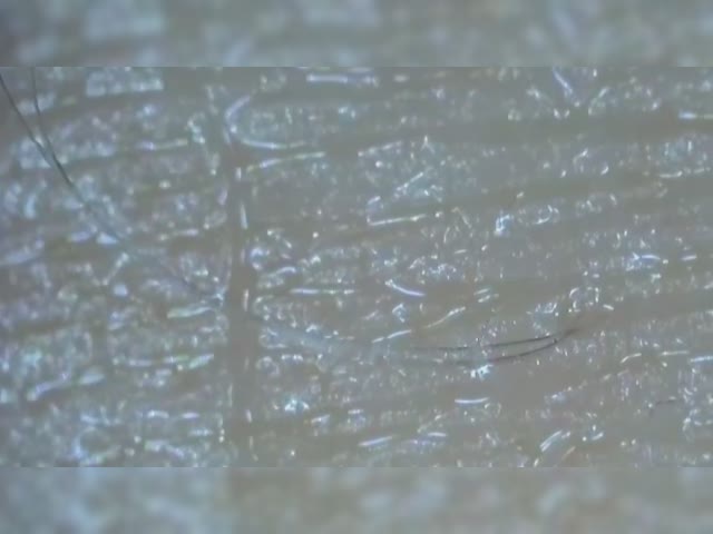 Attached morgellons