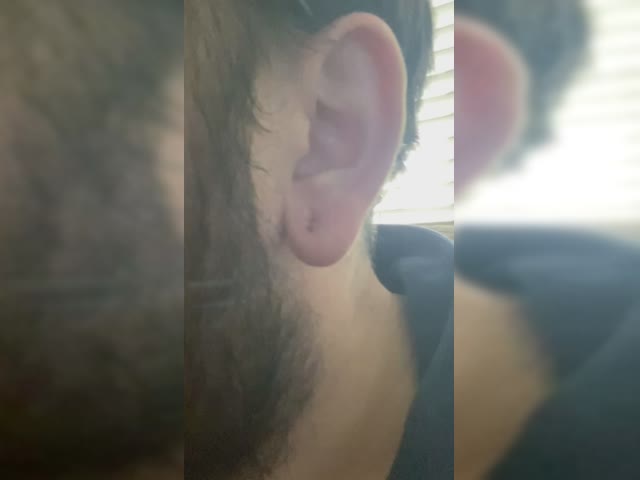 Healed earlobe