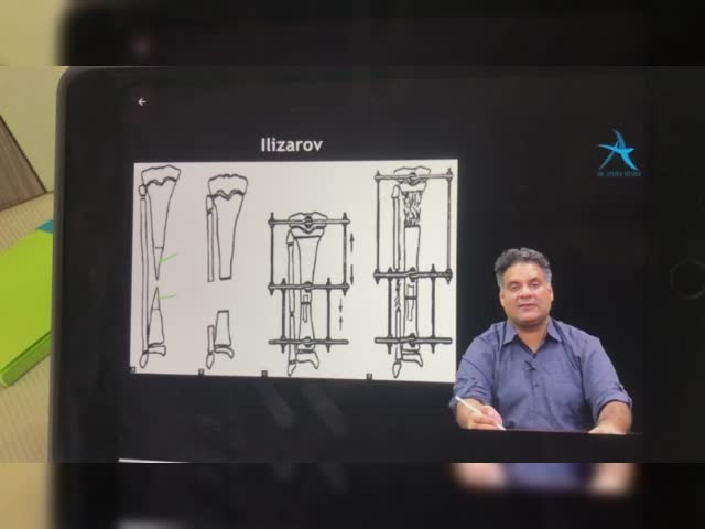 Ilizarox ext fixator